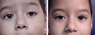 Ptosis - Left Eye