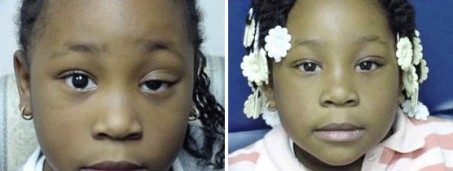 Ptosis - Left Eye