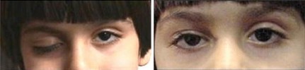 Ptosis - Right Eye
