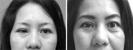 Large-angle Sensory Esotropia - Right Eye
