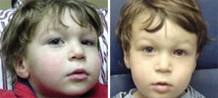 Duane's Syndrome Type 1 - Left Eye